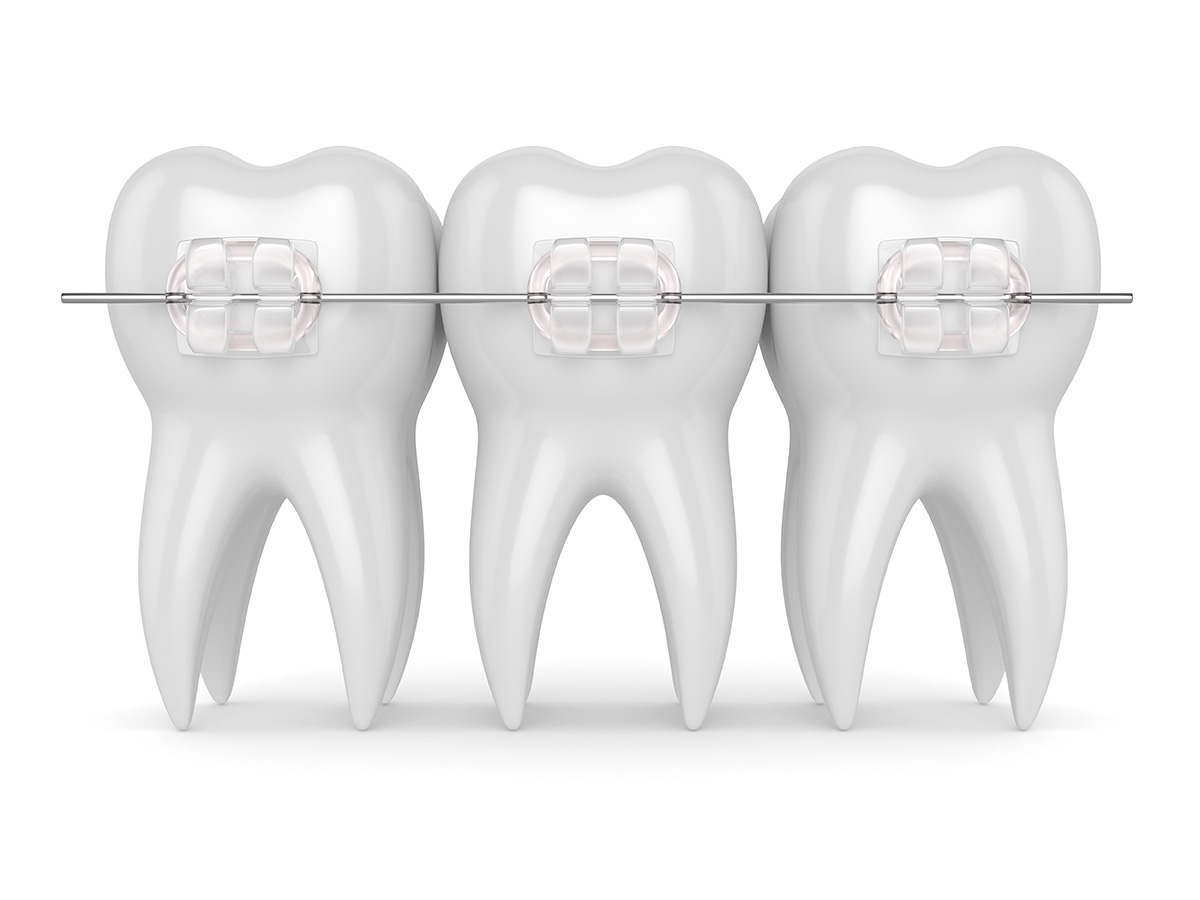 Orthodontics Australia  How are metal and ceramic braces different?