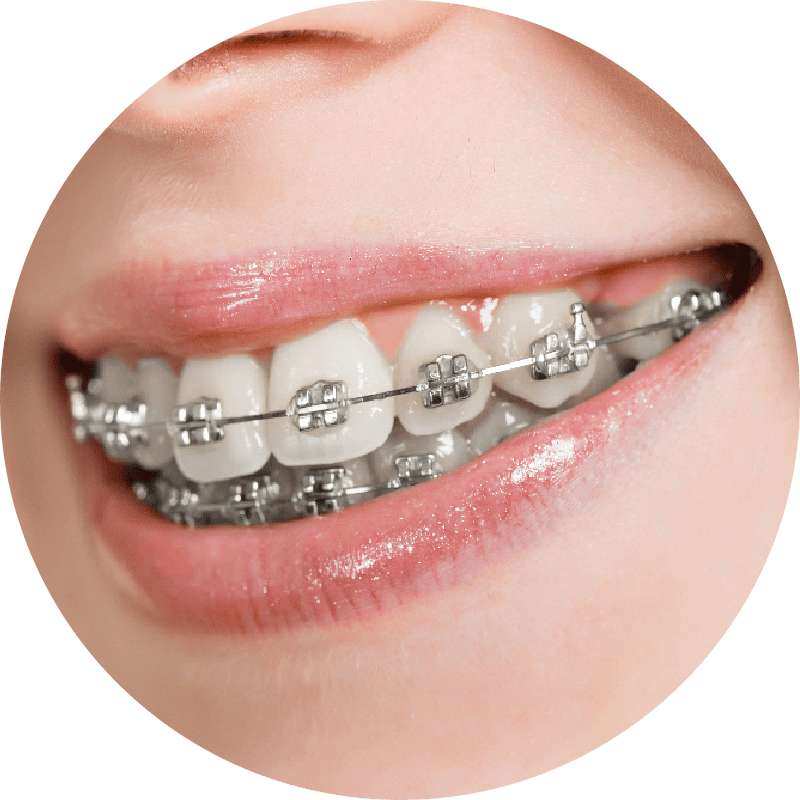 Metal braces (Traditional) braces