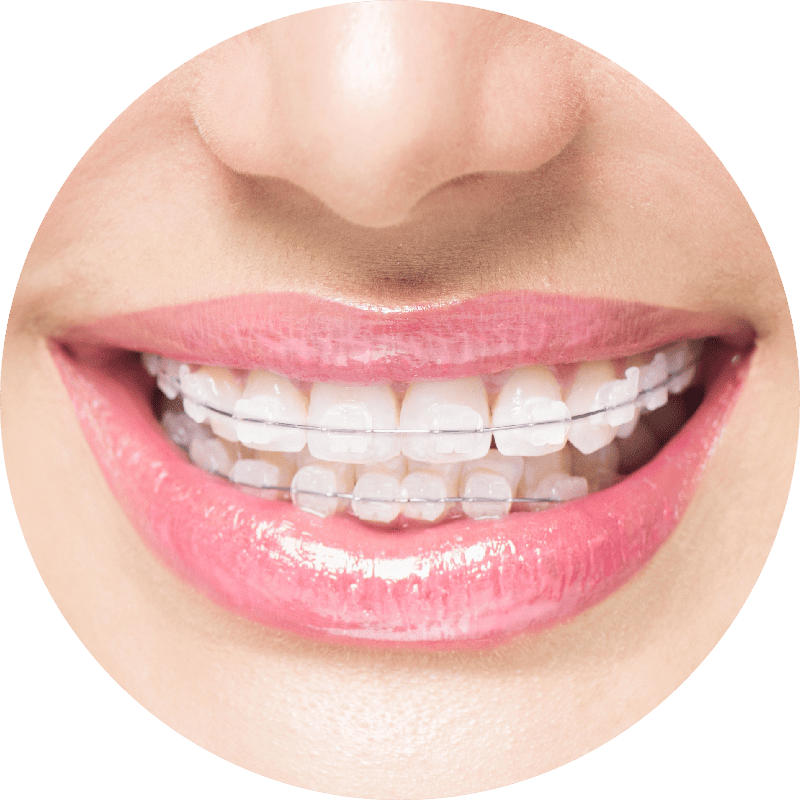 Ceramic Braces